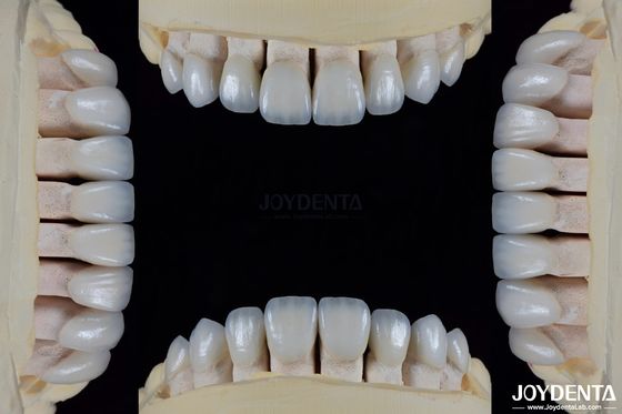 Cerámica para estética natural carillas dentales Resistencia a manchas mantiene el brillo fuerte unión con el esmalte dental para un ajuste seguro