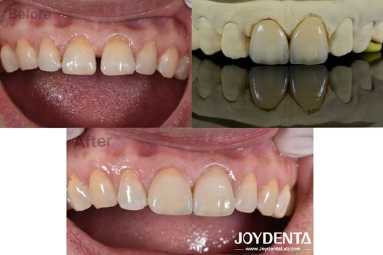 0.5 mm de espesor carillas dentales Permeabilidad perfecta carillas de porcelana para dientes espaciosos