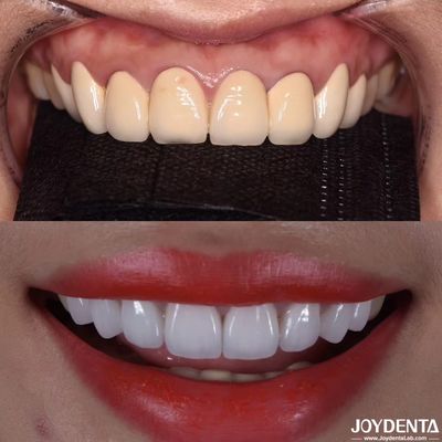 Fabricación de precisión de coronas dentales de zirconia compatibles CAD/CAM para tonos y tamaños personalizados