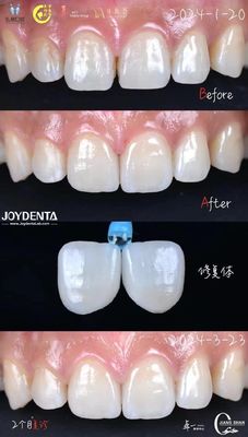 Indicación de los dientes anteriores carillas dentales sin necesidad de preparación y sin decoloración