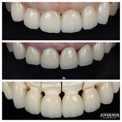 Excelencia en la biocompatibilidad Las carillas de porcelana dental no necesitan un proceso de preparación