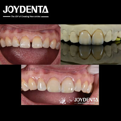 Carillas Dentales de 0.5 mm de Grosor con Perfecta Permeabilidad de Porcelana
