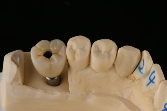 comprar 3Implante dental con tornillo de titanio de plata de 75 mm Implante de reemplazo de diente único fabricación en línea