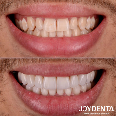 comprar Encasillamiento de dientes de porcelana de ajuste perfecto Encasillamiento de laminado dental de transparencia natural fabricación en línea