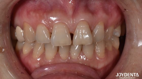 comprar 0.5 mm de espesor carillas dentales de cerámica natural que busca la indicación del diente anterior fabricación en línea