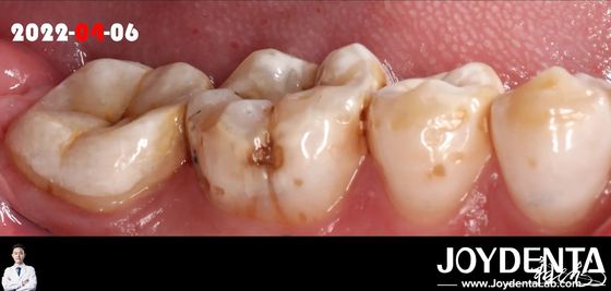 comprar Colores naturales, incrustación dental adecuada para la restauración de dientes dañados fabricación en línea
