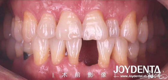 comprar Puentes de resina de Maryland para dientes anteriores y premolares fabricación en línea