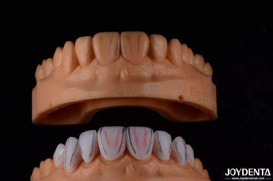 comprar Carillas de cerámica dental Emax hechas a medida con alto brillo resistente a las manchas fabricación en línea