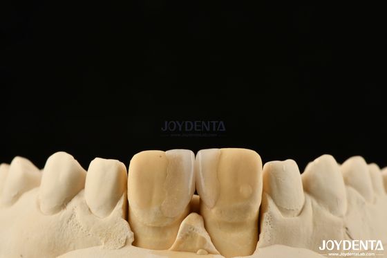 comprar 0.2 mm de espesor Carillas de microtino Carillas dentales cerámicas de vidrio para dientes delanteros fabricación en línea