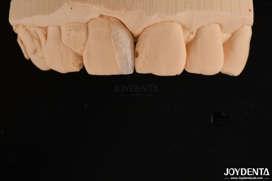 comprar Carcasa delgada micro carcasa tratamiento dental cosmético carcasa delgada delgada de los dientes fabricación en línea