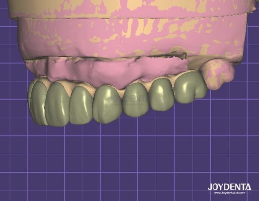 comprar Seguridad de datos compatible con HIPAA Modelo 3D de cera digital para modificaciones dentales fabricación en línea