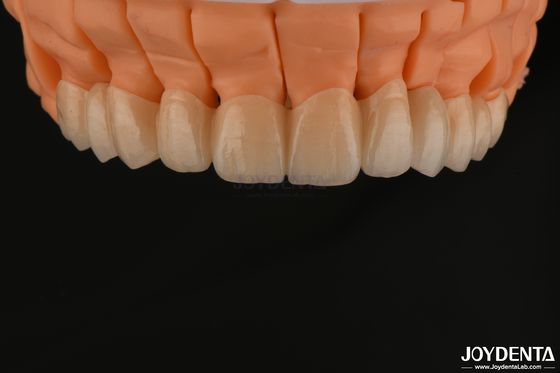 comprar Alta estética de zirconia en capas de corona única puentes de implante para restauraciones dentales fabricación en línea
