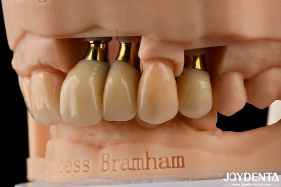comprar Implante dental de precisión Corona y puente Solución perfecta para una sonrisa estética fabricación en línea