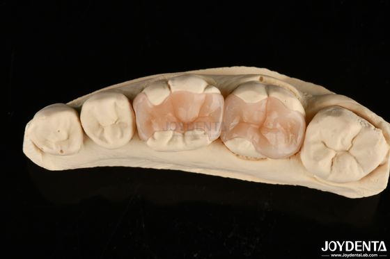 comprar Inlay dental de porcelana polimerizada natural para la restauración dental fabricación en línea
