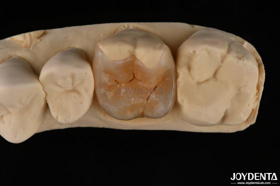 comprar Inlay onlay compuesto personalizado para restauración dental mínimamente invasiva fabricación en línea