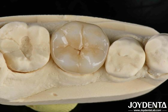 comprar Adhesivo Cementado Zirconia Dental Inlays y Onlays de aspecto natural fabricación en línea