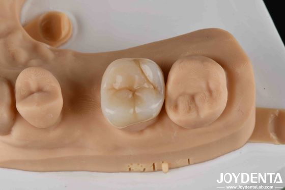 comprar Enlaces dentales y onlays de zirconia de alta resistencia para la restauración dental fabricación en línea
