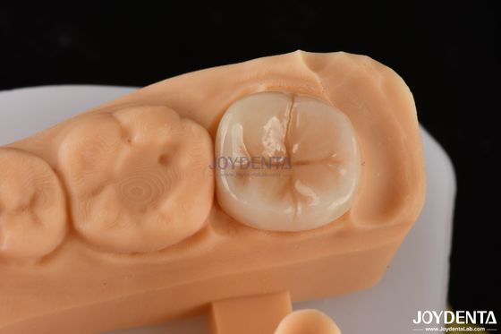 comprar 0.5mm-2mm Precise Fit Emax Dental Inlay Onlay para una restauración dental confiable fabricación en línea
