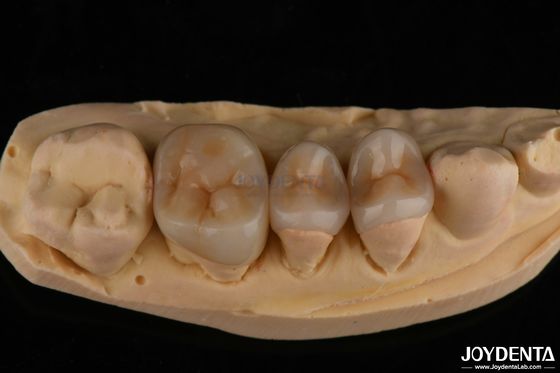 comprar Vista natural Emax Inlay Onlay Restauración dental de larga duración 0,5 mm 1 mm 1,5 mm de espesor fabricación en línea
