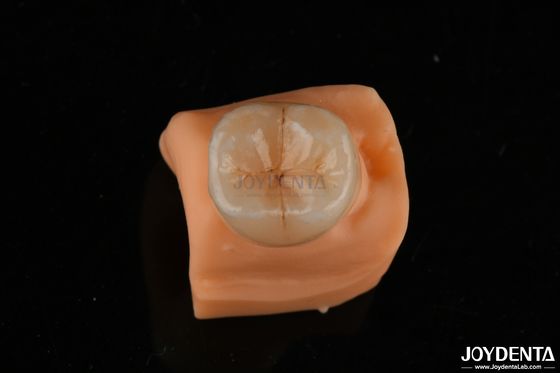 comprar 0.5mm Resistente a manchas Emax Inlay Onlay adecuado para restauraciones dentales fabricación en línea