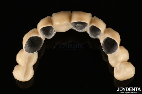 comprar Cerámica PFM fusionada con corona de metal altamente biocompatible y resistente a la corrosión fabricación en línea