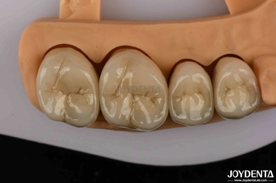 comprar Coronas dentales de oro y de aleación de paladio de primera calidad para una mayor durabilidad fabricación en línea