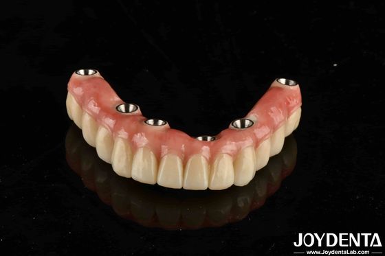 comprar Puente de implantes dentales de titanio malo que combina técnicas tradicionales y modernas fabricación en línea
