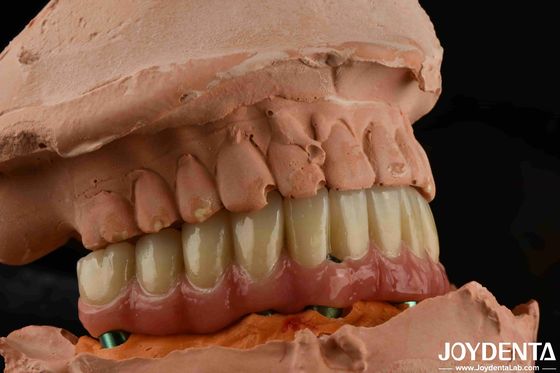 comprar Titanio de baja densidad Puente híbrido Malong Dental de peso ligero Uso cómodo fabricación en línea