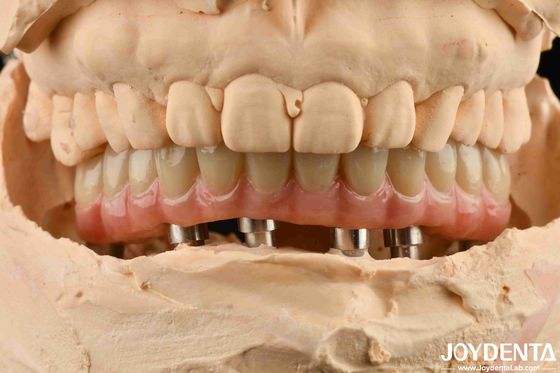 comprar Puente híbrido de implantes dentales de titanio Malong para la perfección dental fabricación en línea