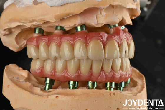 comprar Tecnología híbrida Puente dental de titanio Malong ajustable para resultados estéticos fabricación en línea