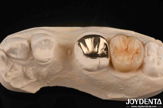 comprar Corona dental de oro resistente al desgaste con 60K metálico fabricación en línea