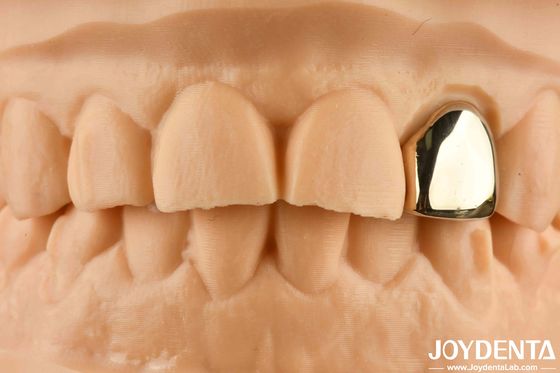 comprar Oro 60K Corona oral metálica resistente a la abrasión Corona dental de cera de fundición fabricación en línea
