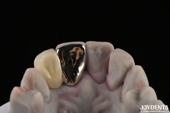 comprar Puente Dental Metálico de Maryland Buena función de masticación para una remediación duradera fabricación en línea