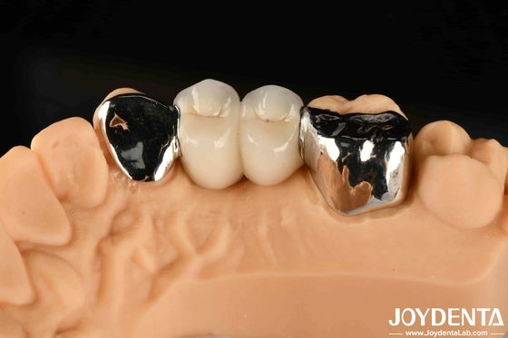 comprar Puente enlazado de Maryland Dental Metálico Buena remediación para la reparación clínica oral fabricación en línea