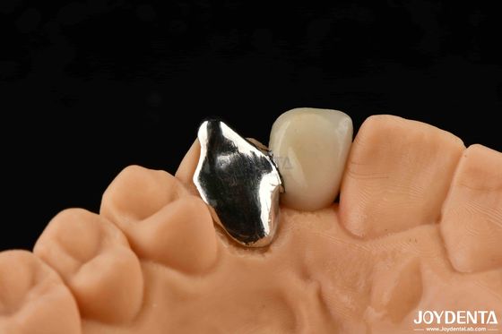 comprar Material metálico personalizable PFM Maryland Cuidado dental Reparación clínica oral fabricación en línea