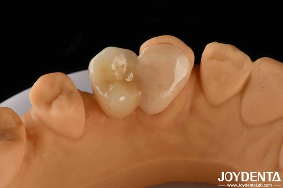 comprar Emax Maryland Veneer Adhesión de unión clínica para la reparación dental de color fabricación en línea