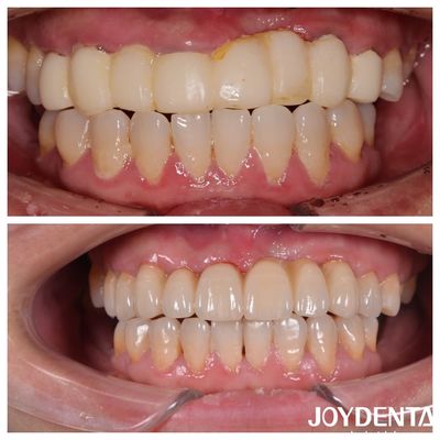 comprar Puentes dentales de zirconia de capas múltiples de color natural para una experiencia óptima del paciente fabricación en línea