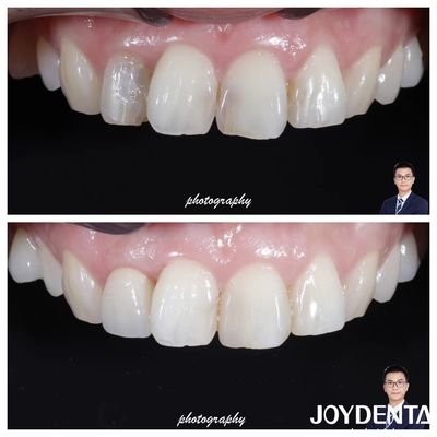 comprar Estética Translucidez Coronas de zirconia de aspecto natural Alta resistencia a las fracturas fabricación en línea