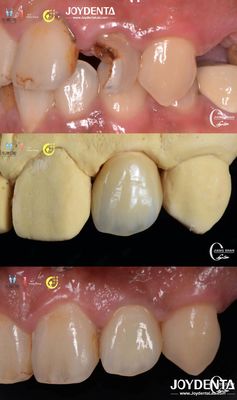 comprar Apariencia dental realista Puentes de zirconia Restauración dental Resistente al desgaste Personalizado fabricación en línea