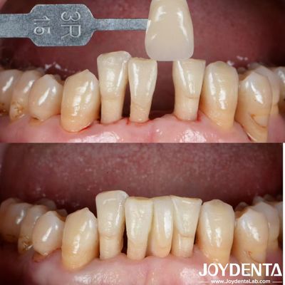 comprar Forma natural Cerámica puente de Maryland de unión Restauración dental Excelente estética fabricación en línea