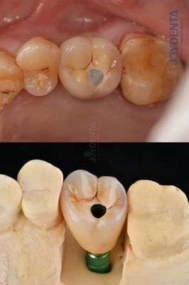 comprar Implantes dentales de arco completo de titanio Plataforma protética 4.1 mm para una durabilidad excepcional fabricación en línea