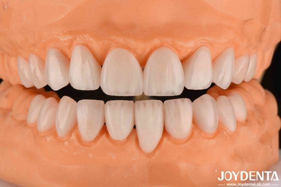 comprar Carillas de cerámica Emax 0,3-0,5 mm de espesor Carillas de porcelana cosmética de larga duración fabricación en línea