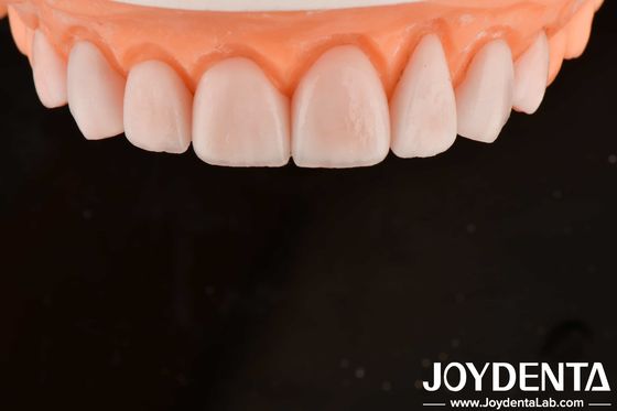 comprar Fabricación a medida IPS Porcelana Emax Carillas Restauraciones dentales Resistente a las astillas fabricación en línea