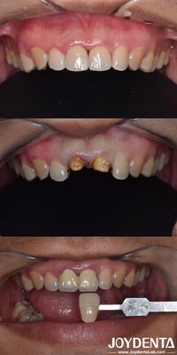 comprar Técnica de preparación orientada biológicamente Preparación dental vertical mínimamente invasiva fabricación en línea