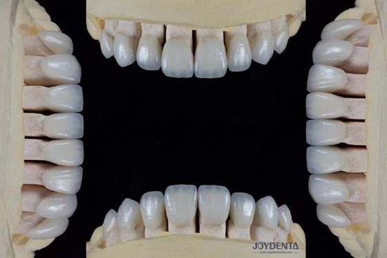 comprar Veneer feldespático ultra delgado 0,3-0,5 mm espesor alta resistencia a las manchas ajuste preciso fabricación en línea