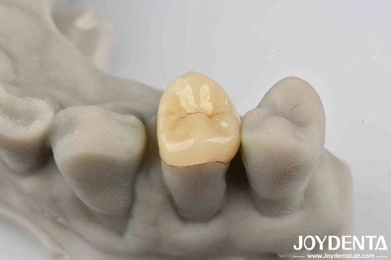 comprar Cementado seguro Emax Inlay Onlay fácil de limpiar y resistente a las manchas fabricación en línea