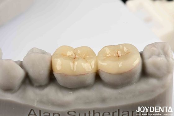 comprar Emax Inlay Onlay ajuste preciso y biocompatibilidad hipoalergénica fácil de limpiar fabricación en línea