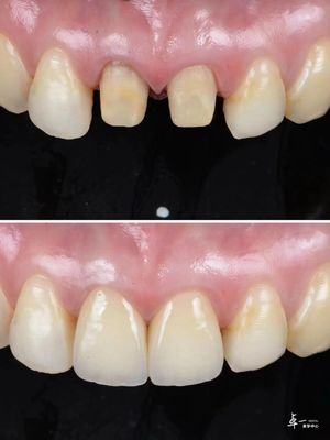 comprar Las carillas hechas con alta resistencia a la fractura de zirconia dental y tecnología de gradiente multicapa fabricación en línea