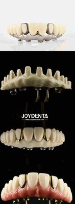 comprar Puente híbrido de titanio Malong, solución definitiva para la restauración dental fabricación en línea