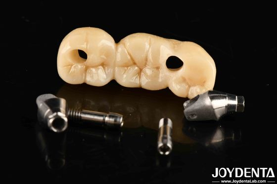 comprar Implante fuerte corona y puente solución perfecta para una estética estéticamente agradable fabricación en línea